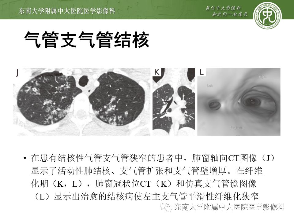 【病例】复发性多软骨炎1例CT影像