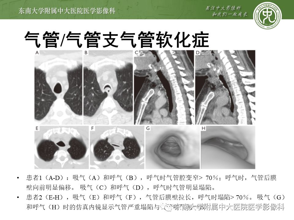 【病例】复发性多软骨炎1例CT影像