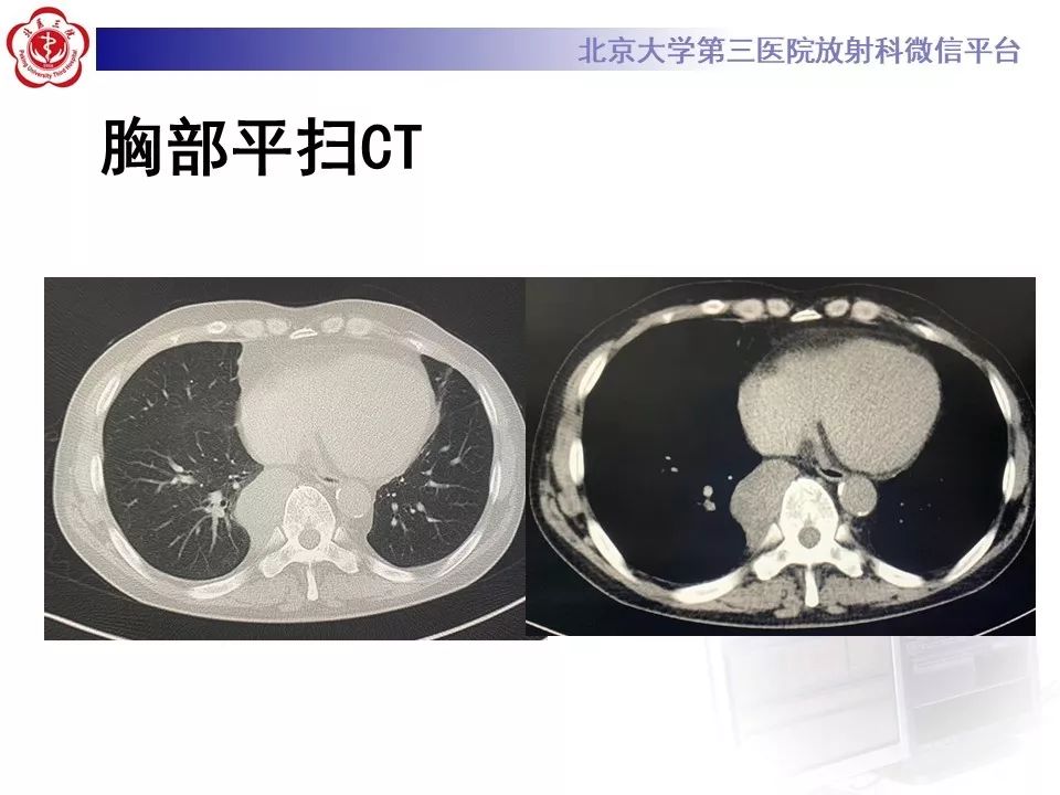 【病例】纵隔髓脂肪瘤1例CT