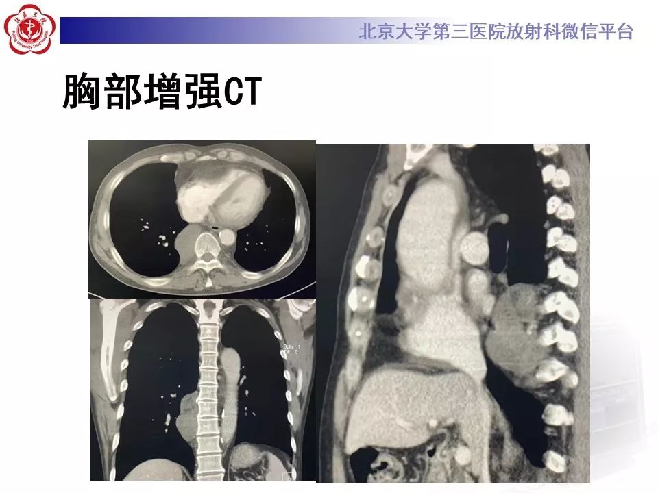 【病例】纵隔髓脂肪瘤1例CT