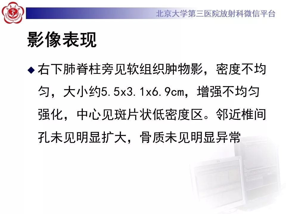 【病例】纵隔髓脂肪瘤1例CT