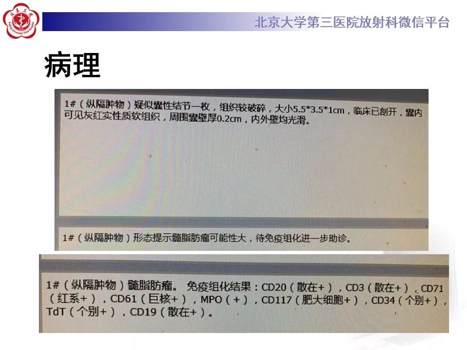 【病例】纵隔髓脂肪瘤1例CT