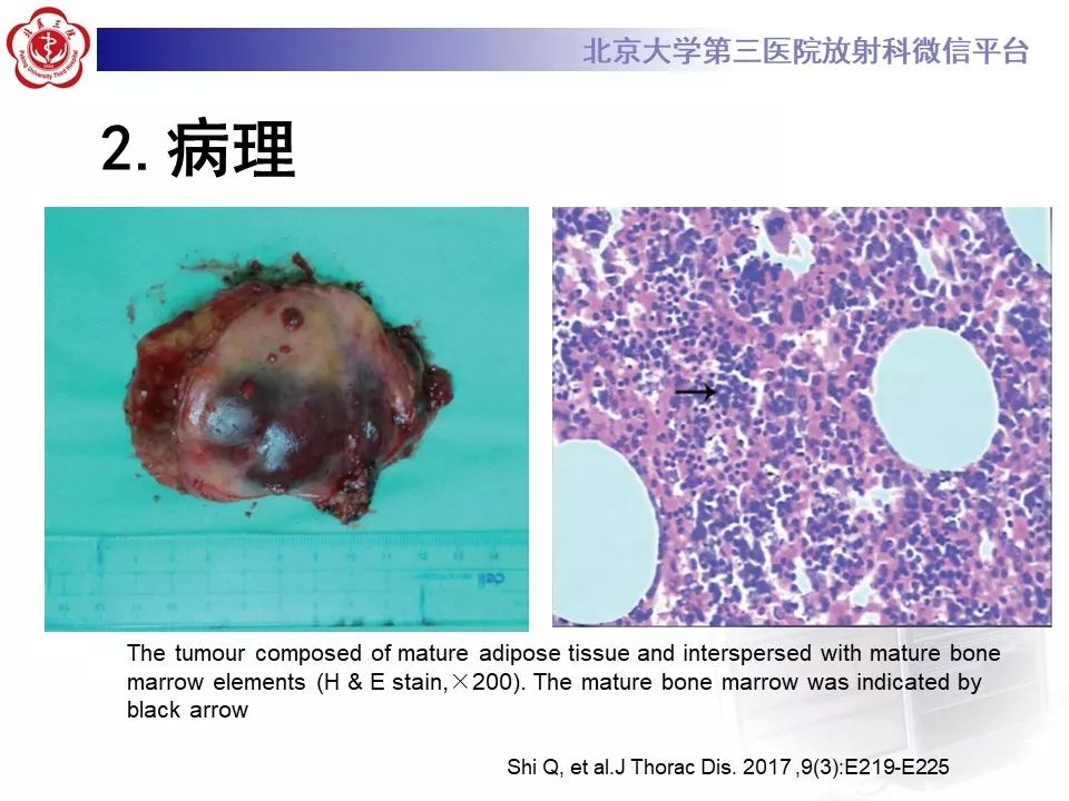 【病例】纵隔髓脂肪瘤1例CT