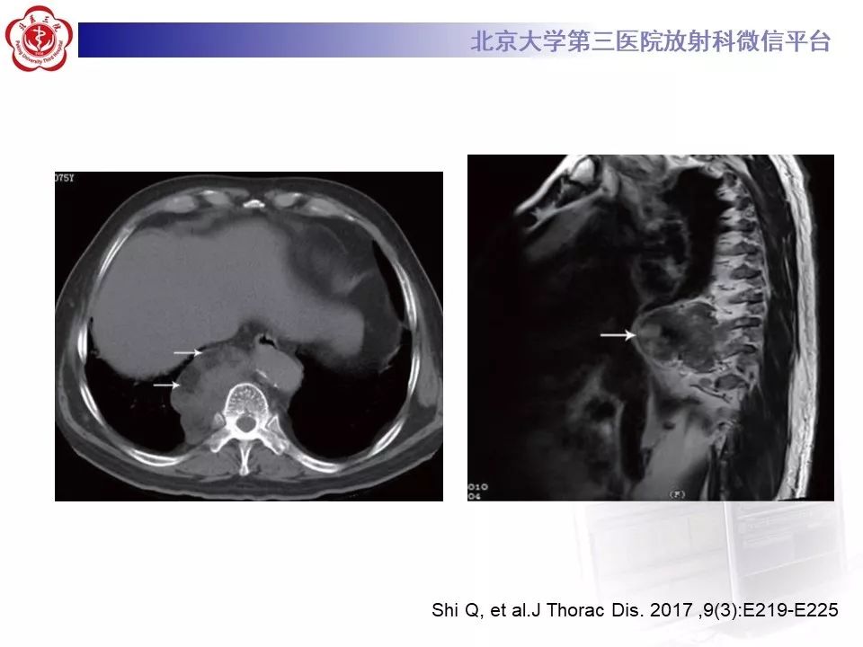 【病例】纵隔髓脂肪瘤1例CT