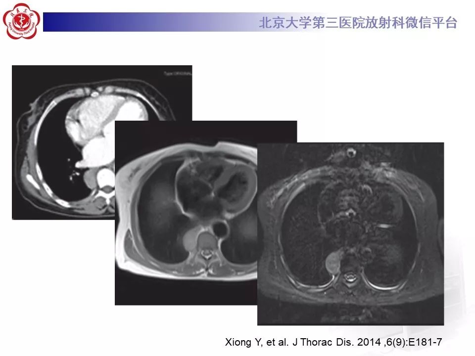 【病例】纵隔髓脂肪瘤1例CT