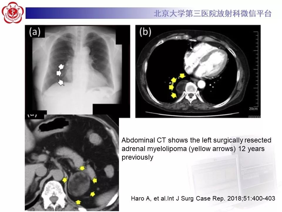 【病例】纵隔髓脂肪瘤1例CT