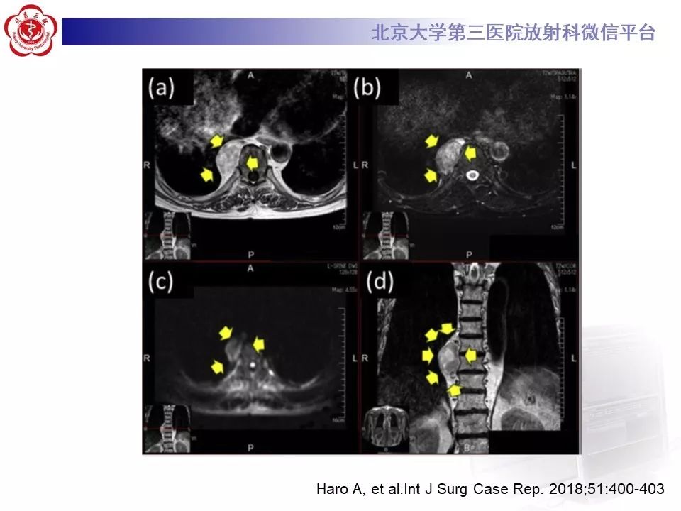 【病例】纵隔髓脂肪瘤1例CT