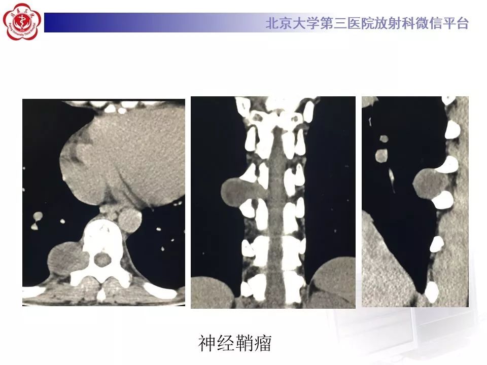 【病例】纵隔髓脂肪瘤1例CT