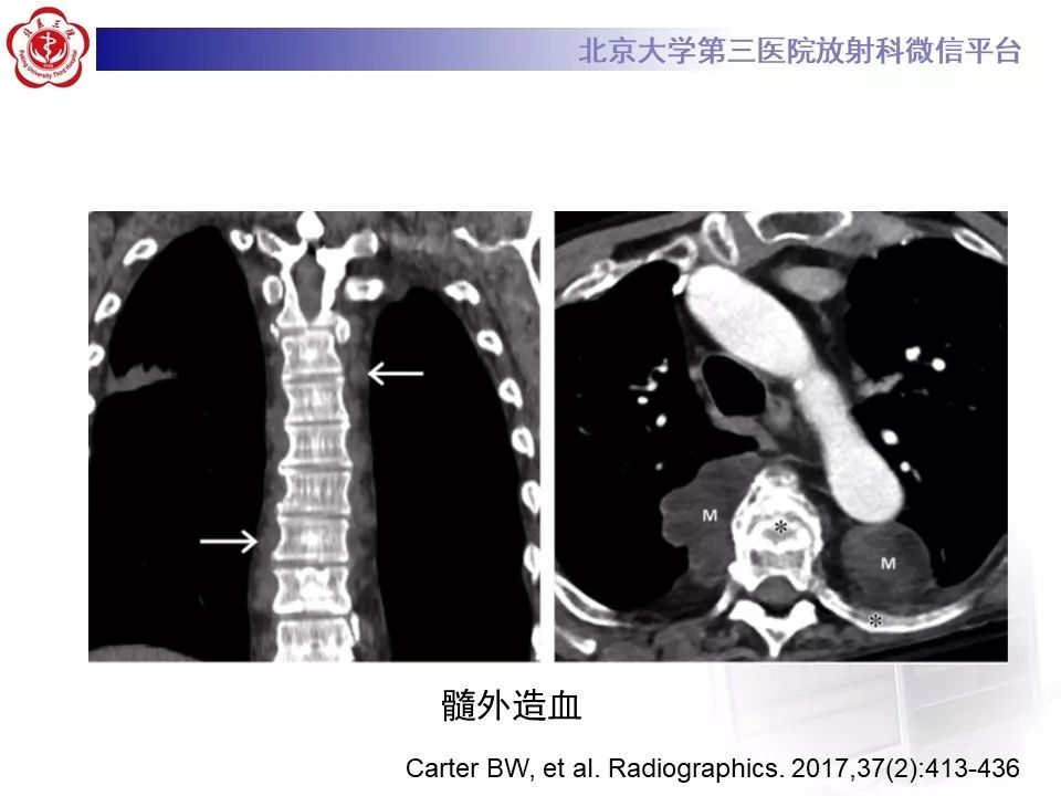 【病例】纵隔髓脂肪瘤1例CT