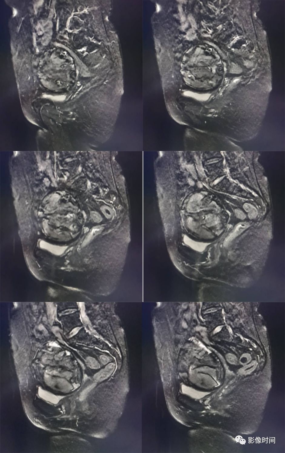 【病例】胎儿石化1例CT及MR影像 【病例】胎儿石化1例CT及MR影像