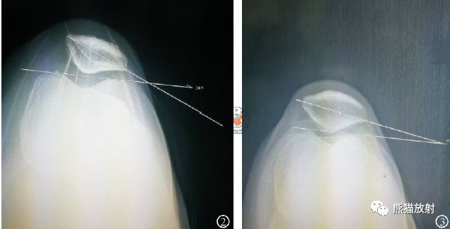 髌骨外倾角的X线测量、应用