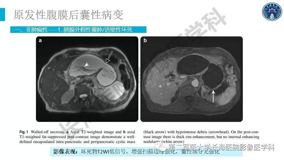 【PPT】原发性腹膜后囊性病变影像特征