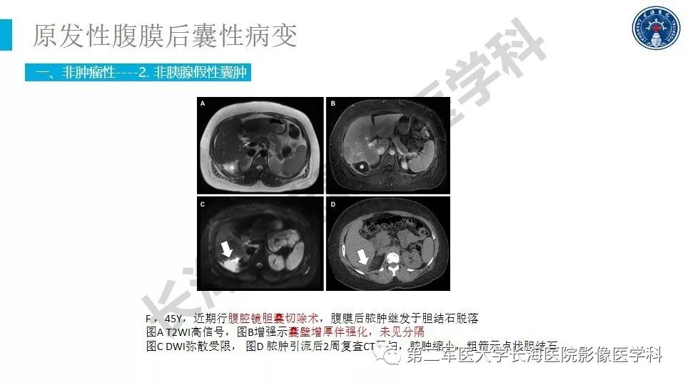 【PPT】原发性腹膜后囊性病变影像特征