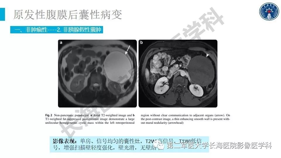 【PPT】原发性腹膜后囊性病变影像特征