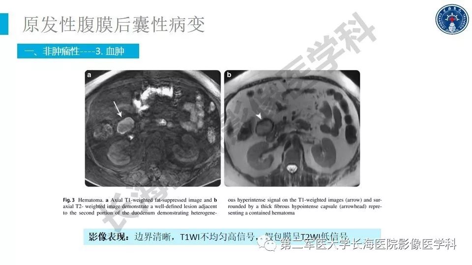 【PPT】原发性腹膜后囊性病变影像特征