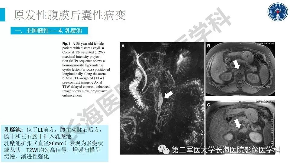 【PPT】原发性腹膜后囊性病变影像特征