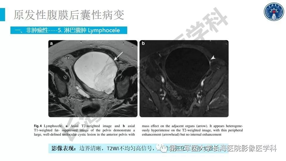 【PPT】原发性腹膜后囊性病变影像特征