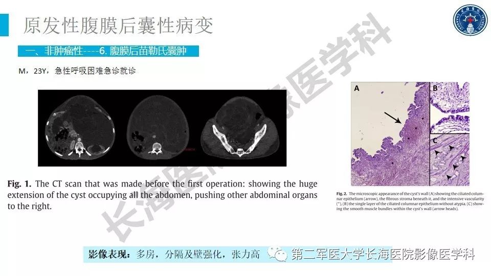 【PPT】原发性腹膜后囊性病变影像特征