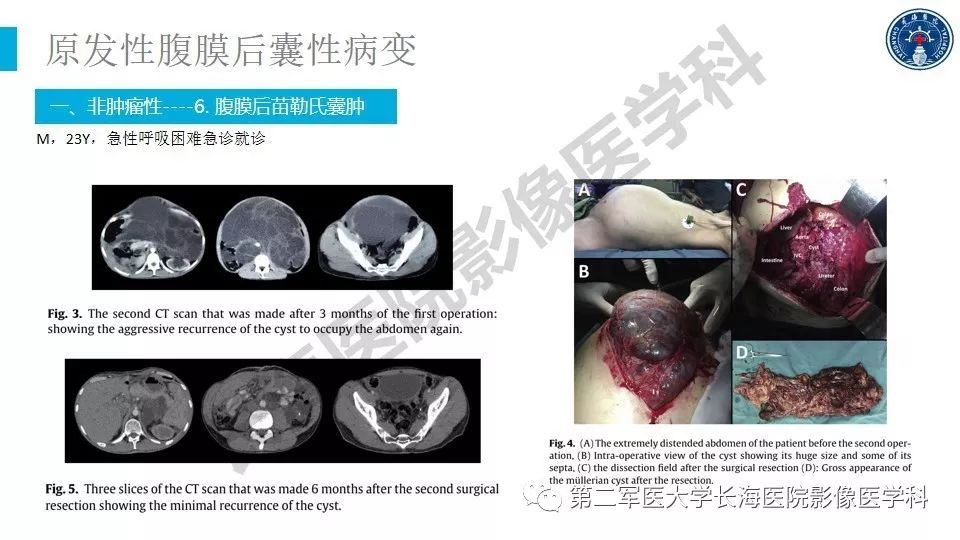 【PPT】原发性腹膜后囊性病变影像特征