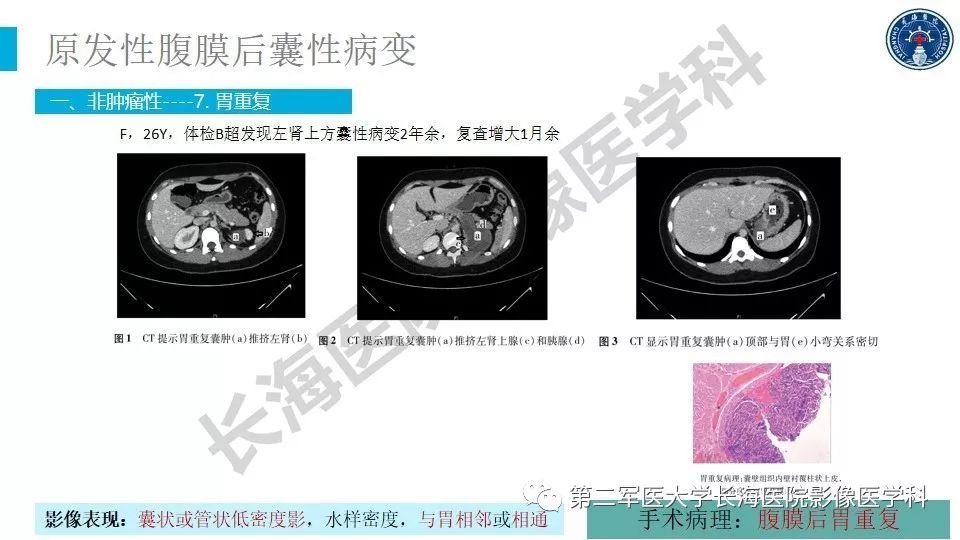 【PPT】原发性腹膜后囊性病变影像特征