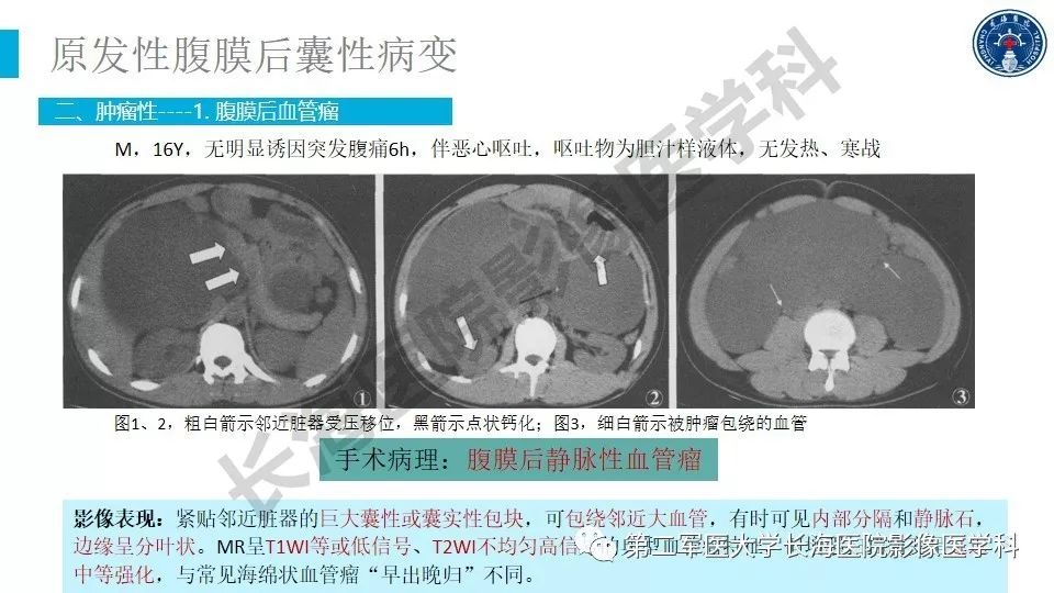 【PPT】原发性腹膜后囊性病变影像特征
