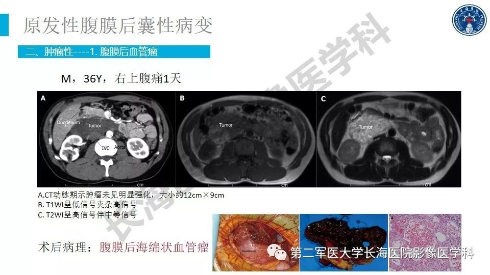 【PPT】原发性腹膜后囊性病变影像特征