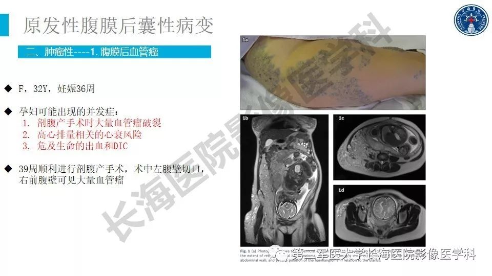 【PPT】原发性腹膜后囊性病变影像特征