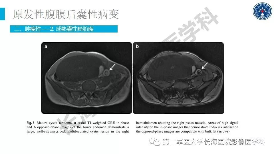 【PPT】原发性腹膜后囊性病变影像特征
