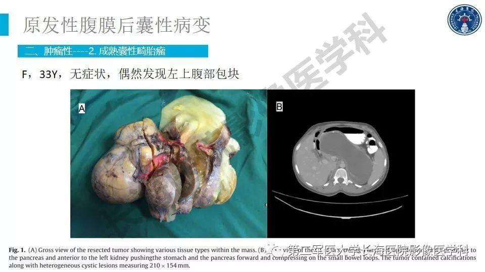 【PPT】原发性腹膜后囊性病变影像特征