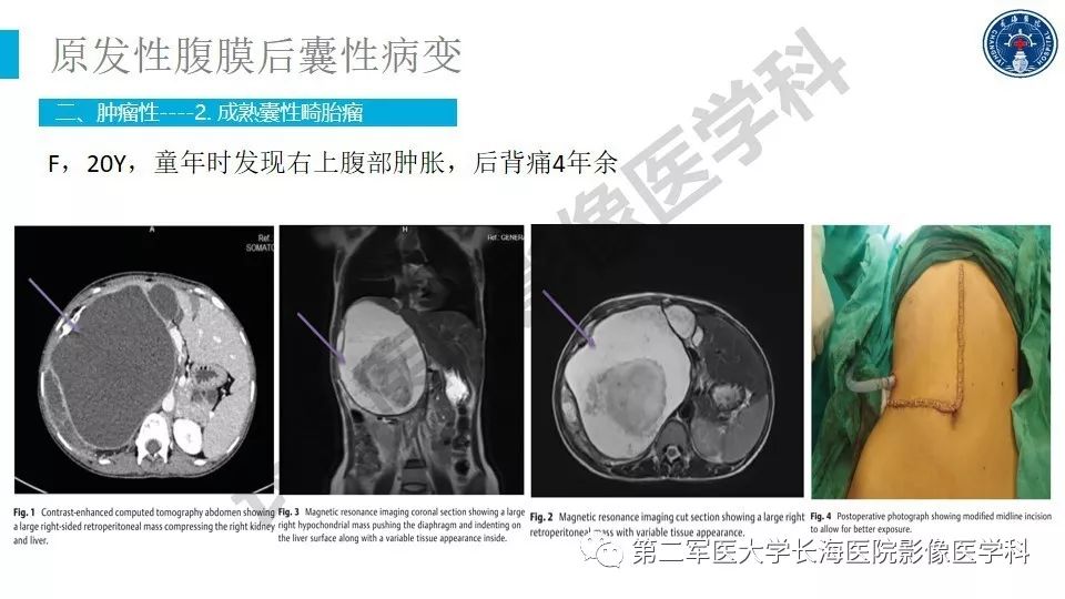 【PPT】原发性腹膜后囊性病变影像特征