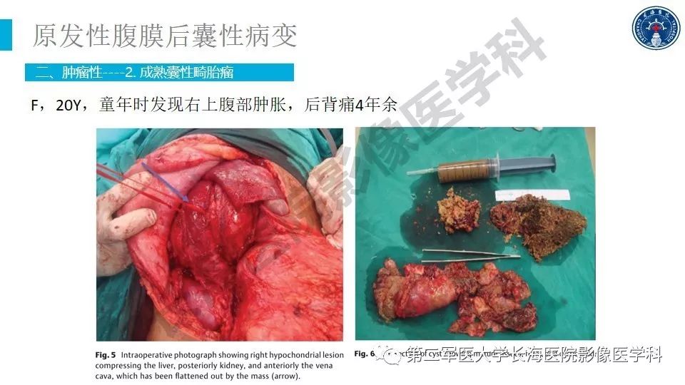 【PPT】原发性腹膜后囊性病变影像特征