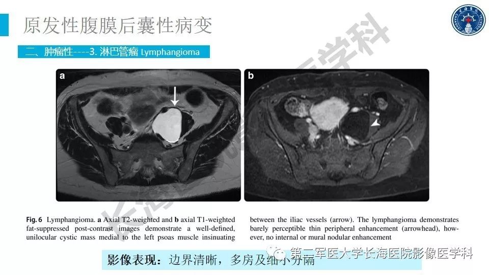 【PPT】原发性腹膜后囊性病变影像特征