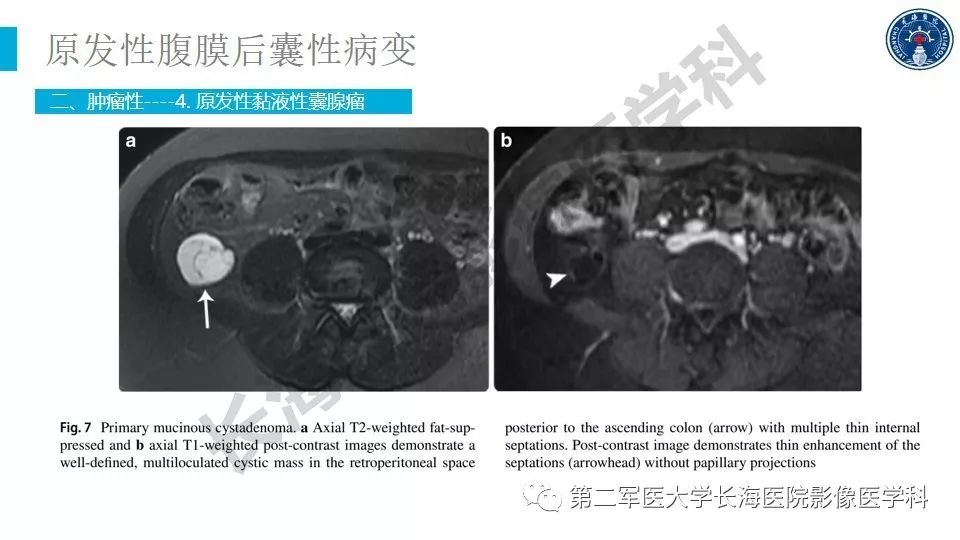【PPT】原发性腹膜后囊性病变影像特征