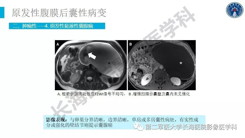 【PPT】原发性腹膜后囊性病变影像特征