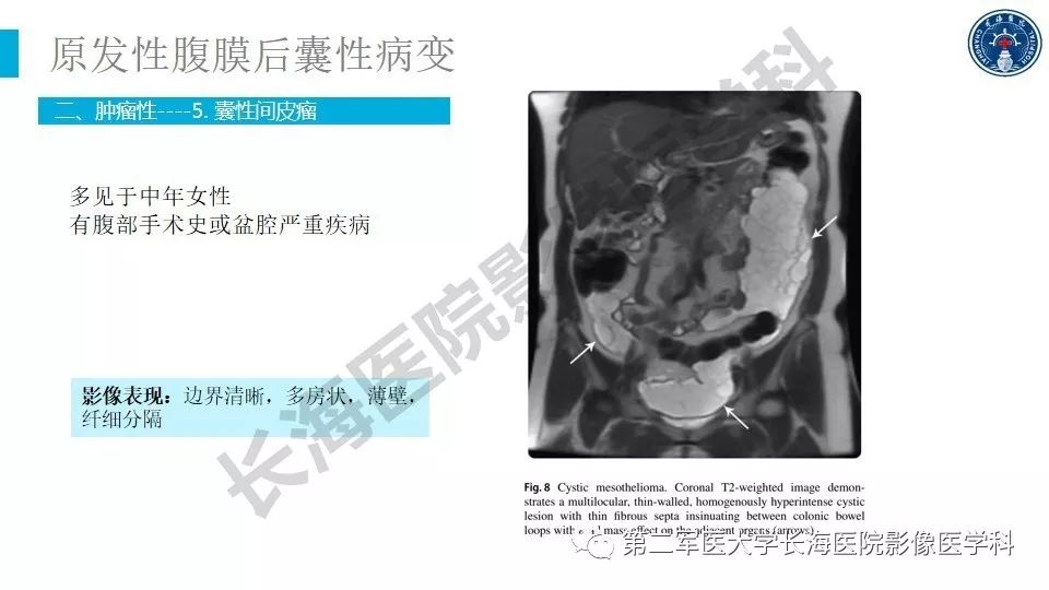 【PPT】原发性腹膜后囊性病变影像特征