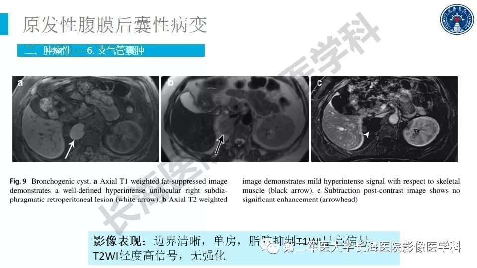 【PPT】原发性腹膜后囊性病变影像特征