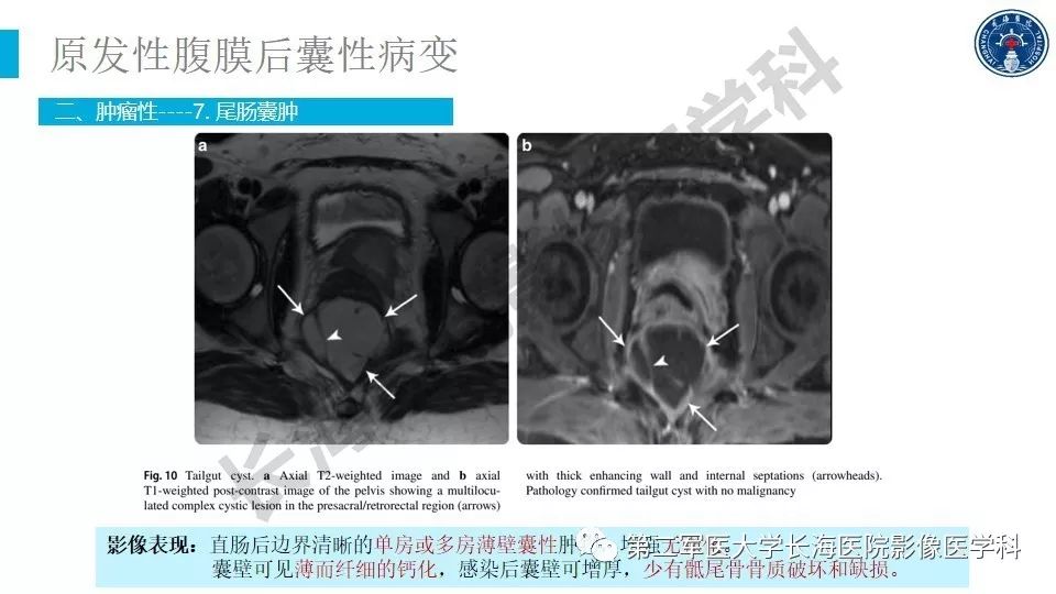 【PPT】原发性腹膜后囊性病变影像特征