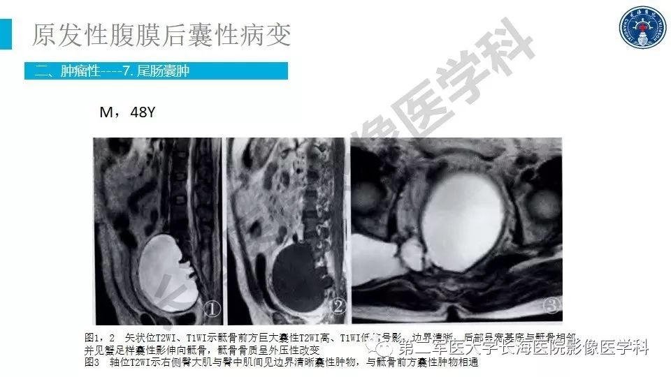 【PPT】原发性腹膜后囊性病变影像特征