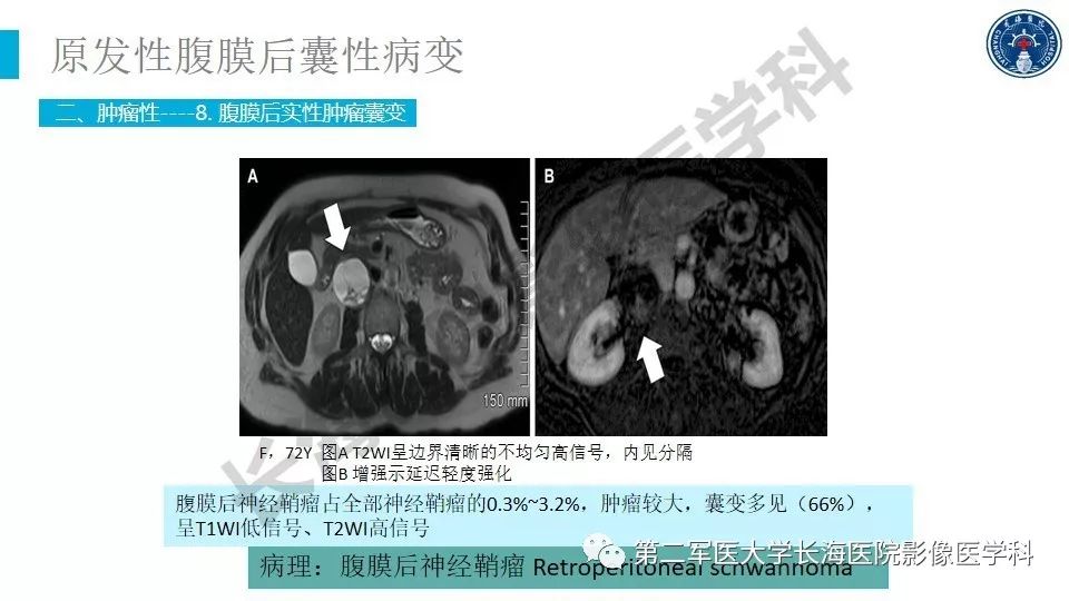 【PPT】原发性腹膜后囊性病变影像特征