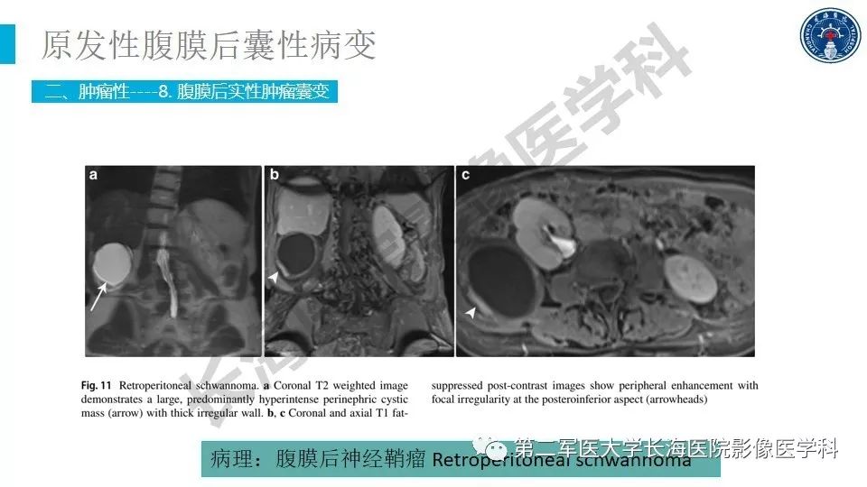 【PPT】原发性腹膜后囊性病变影像特征