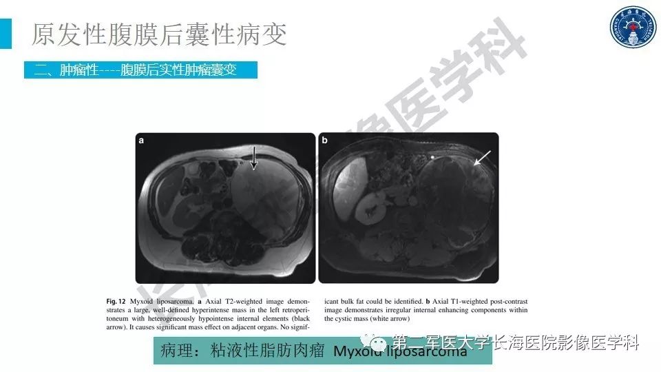 【PPT】原发性腹膜后囊性病变影像特征