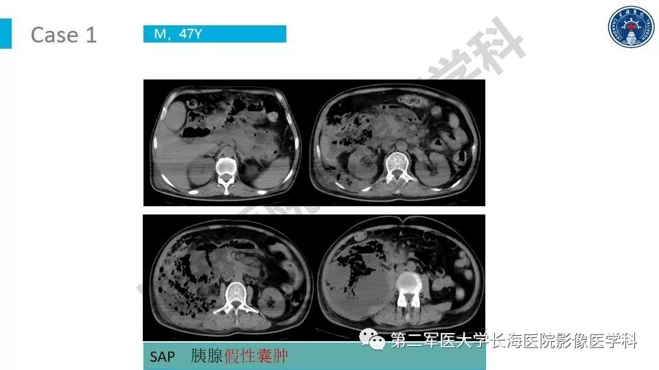 【PPT】原发性腹膜后囊性病变影像特征
