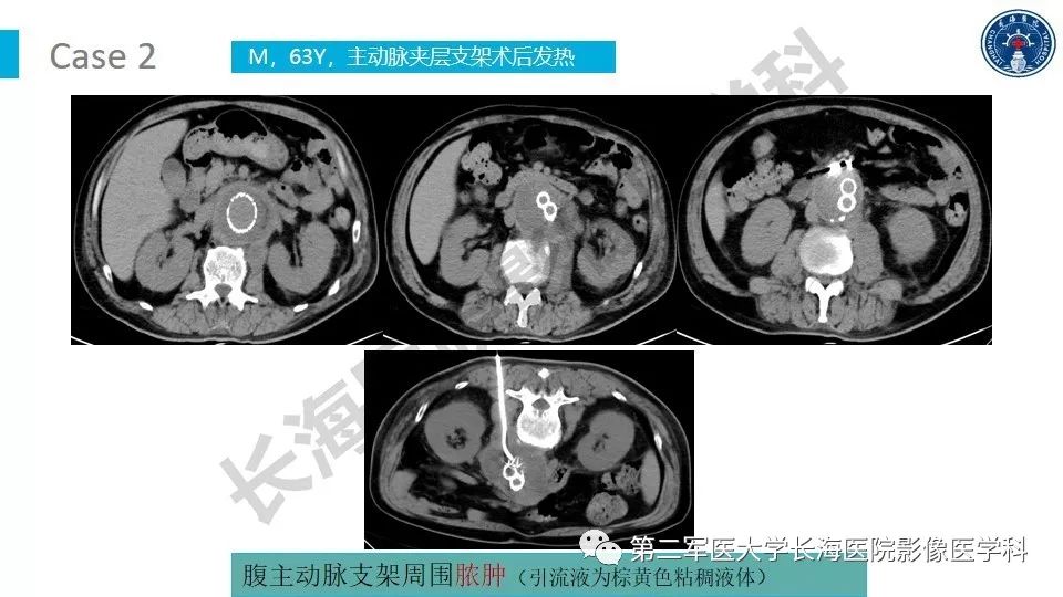 【PPT】原发性腹膜后囊性病变影像特征