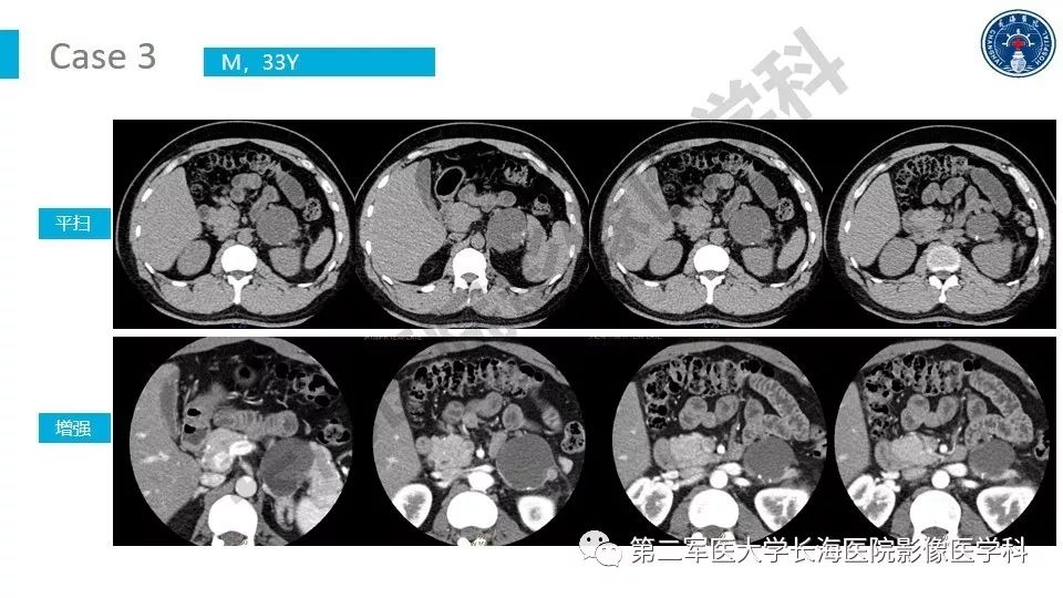 【PPT】原发性腹膜后囊性病变影像特征