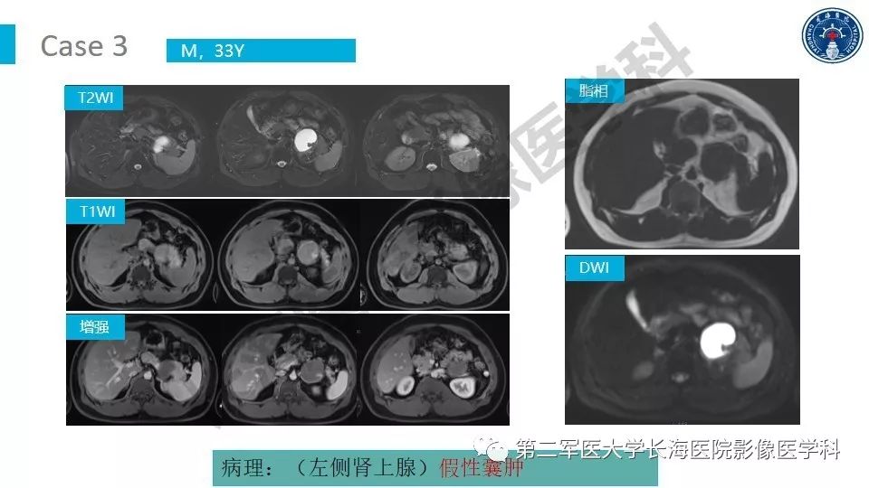 【PPT】原发性腹膜后囊性病变影像特征