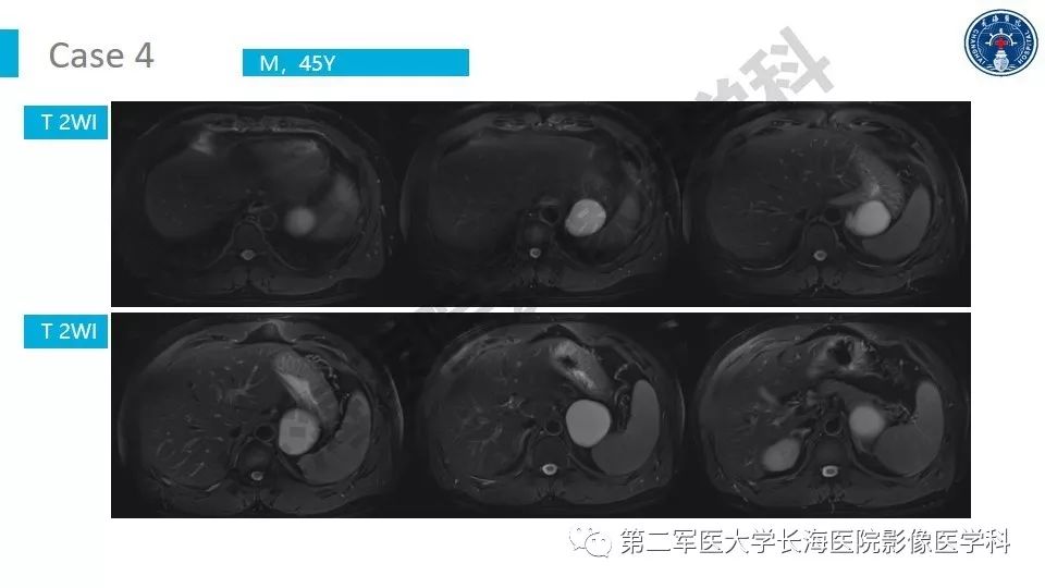 【PPT】原发性腹膜后囊性病变影像特征