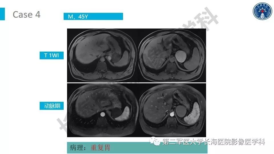 【PPT】原发性腹膜后囊性病变影像特征