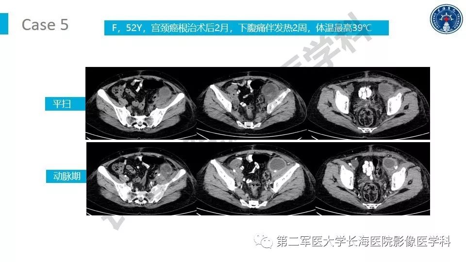 【PPT】原发性腹膜后囊性病变影像特征