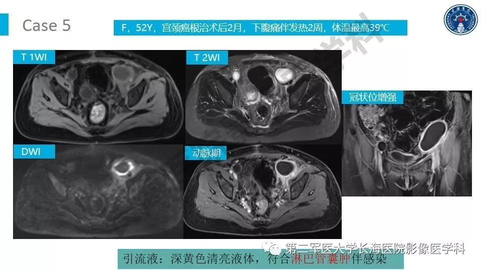 【PPT】原发性腹膜后囊性病变影像特征