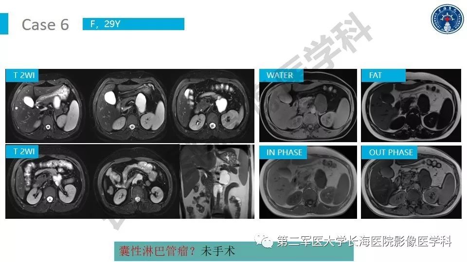 【PPT】原发性腹膜后囊性病变影像特征